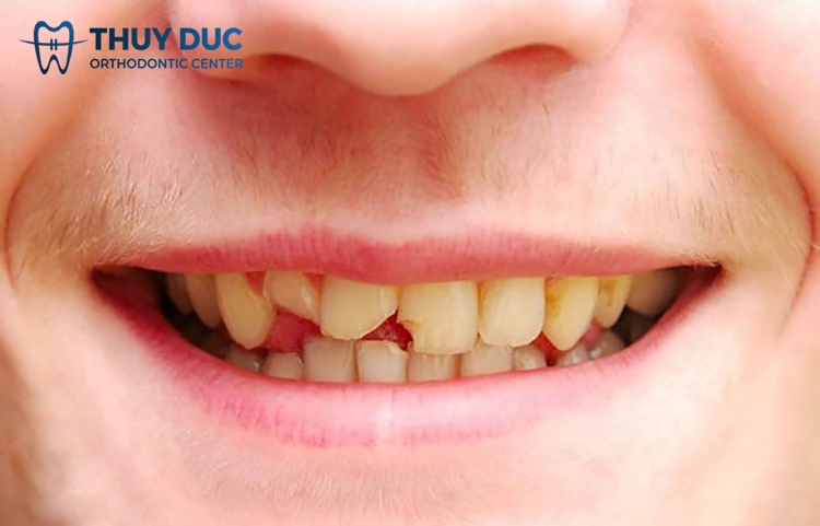 Can I get braces if I have a broken tooth? 1 Can I get braces if I have a broken tooth? 1