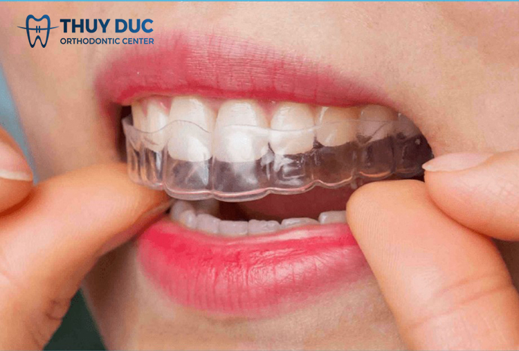 3. Things to keep in mind when wearing a retainer 1 3. Things to keep in mind when wearing a retainer 1