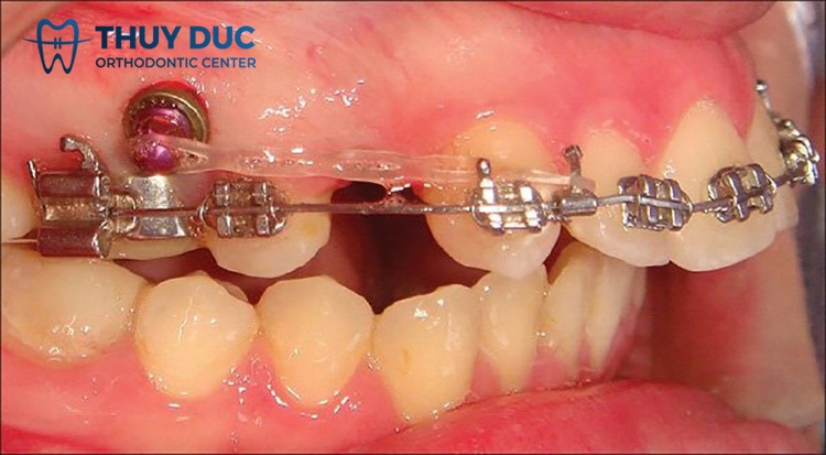 In what cases do braces screws need to be inserted? 2 In what cases do braces screws need to be inserted? 2