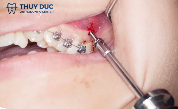 How to fix inflammation when inserting braces screws? 1 How to fix inflammation when inserting braces screws? 1