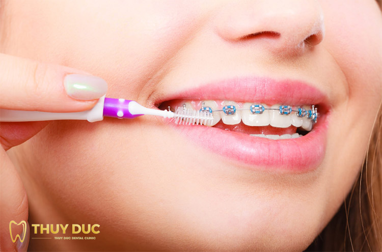 How to take care of your teeth when wearing braces 1 How to take care of your teeth when wearing braces 1
