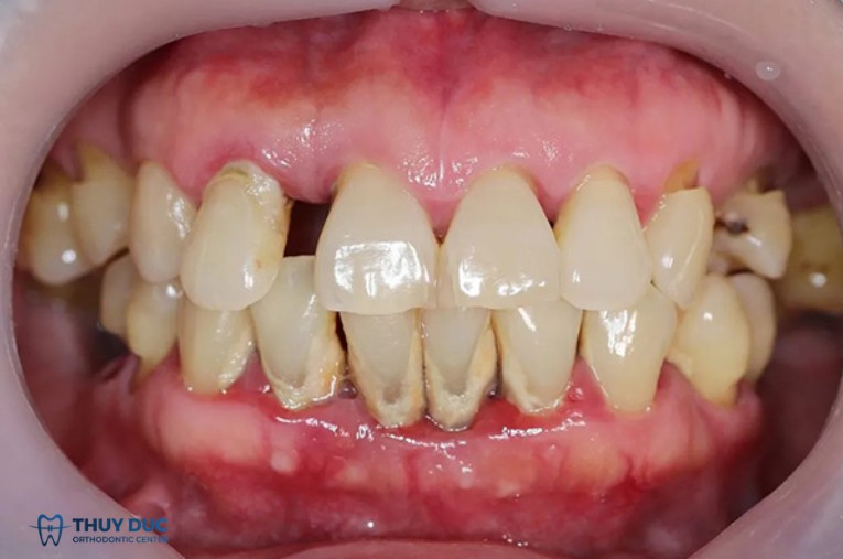 Understanding the Periodontium: The Foundation of Your Smile 1