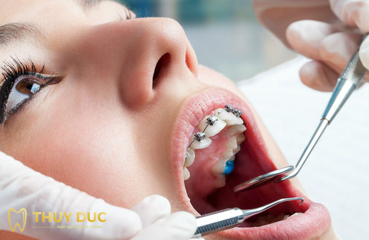 How to fix loose front teeth with braces 1 How to fix loose front teeth with braces 1