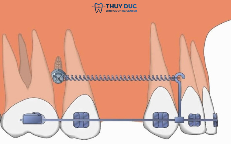 In what cases do braces screws need to be inserted? 1 In what cases do braces screws need to be inserted? 1