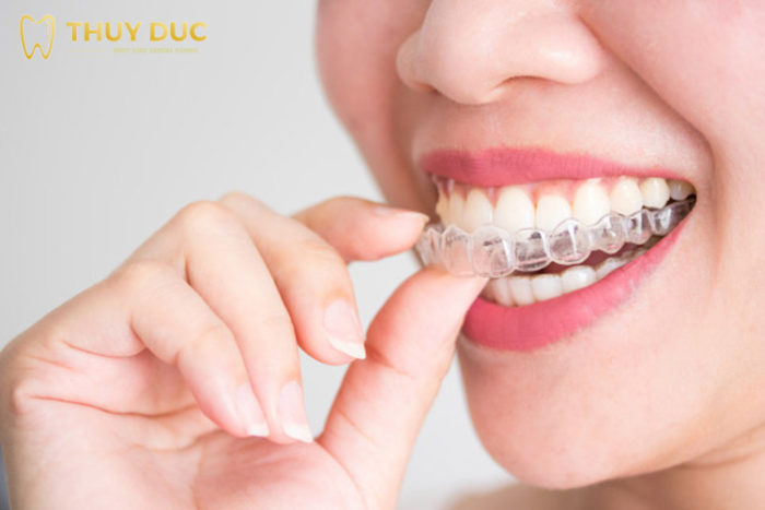 What are Invisalign clear braces? 1 What are Invisalign clear braces? 1