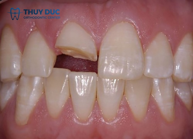 Can I get braces if I have a broken tooth? 1 Can I get braces if I have a broken tooth? 1
