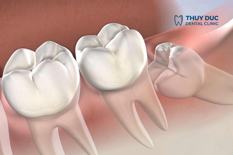What is an Impacted Wisdom Tooth? 1 What is an Impacted Wisdom Tooth? 1