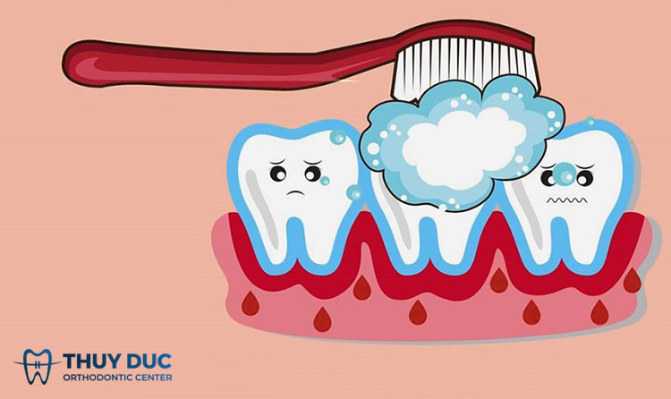 3. Should you brush your teeth if you have dengue fever? 1 3. Should you brush your teeth if you have dengue fever? 1