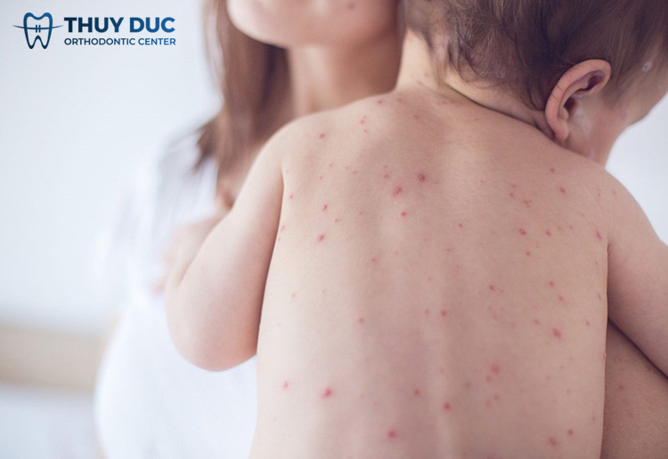 Is dengue fever dangerous? 1 Is dengue fever dangerous? 1
