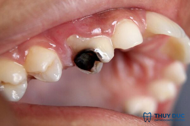 Before porcelain crowns, dental diseases cannot be thoroughly treated 1 Before porcelain crowns, dental diseases cannot be thoroughly treated 1