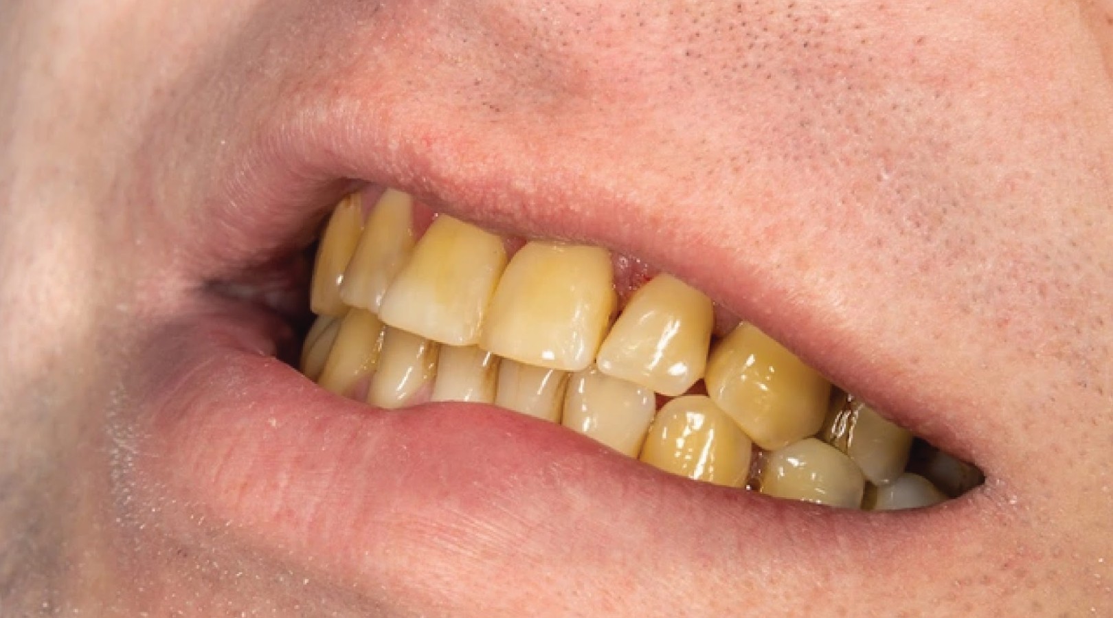 Porcelain dental crowns 1 Porcelain dental crowns 1