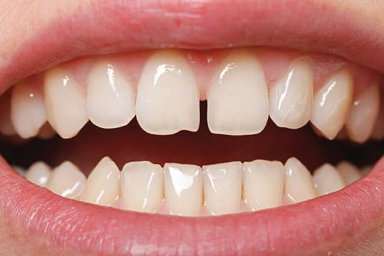 Porcelain dental crowns 4 Porcelain dental crowns 4