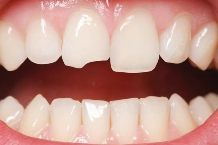 Porcelain dental crowns 3 Porcelain dental crowns 3