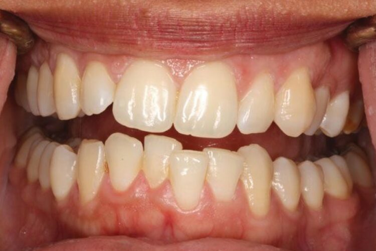 Porcelain dental crowns 2 Porcelain dental crowns 2