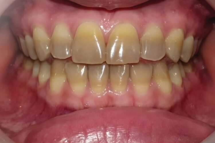 Porcelain dental crowns 5 Porcelain dental crowns 5