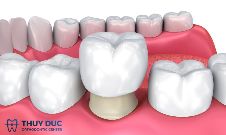 2.1. Grinding teeth, invading real teeth 1 2.1. Grinding teeth, invading real teeth 1