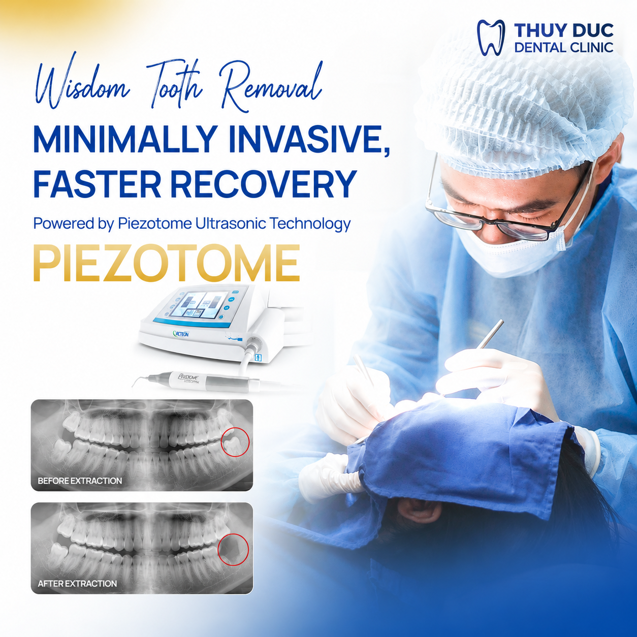Pain-Free Extraction with Piezotome Technology 1 Pain-Free Extraction with Piezotome Technology 1
