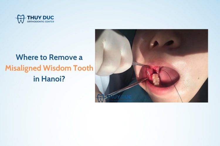 Where to Remove a Misaligned Wisdom Tooth in Hanoi?